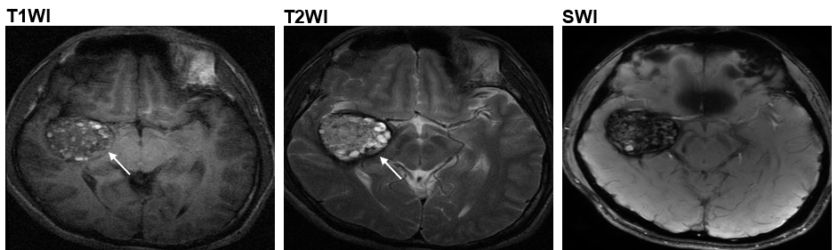 CCM二型患者于脑血管中长有爆谷形状肿瘤 (箭嘴示)
