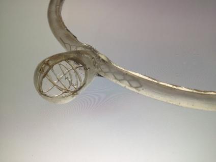  Biodegradable aneurysmal coil (for treating hemorrhagic stroke): aims to reduce aneurysm pressure and allow the aneurysm to shrink; then the coil gradually degrades and vanishes within the body.